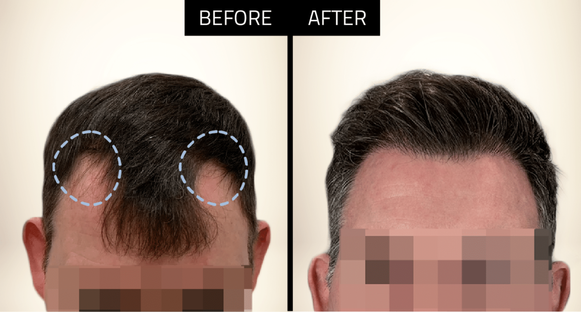 Understanding the Hair Transplant Process in the UK